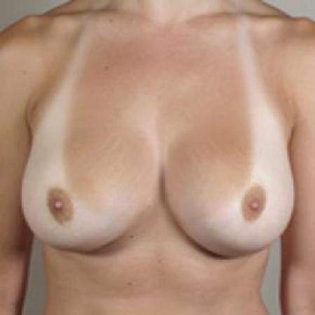 After image 1 Case #80641 - Breast Augmentation New Jersey