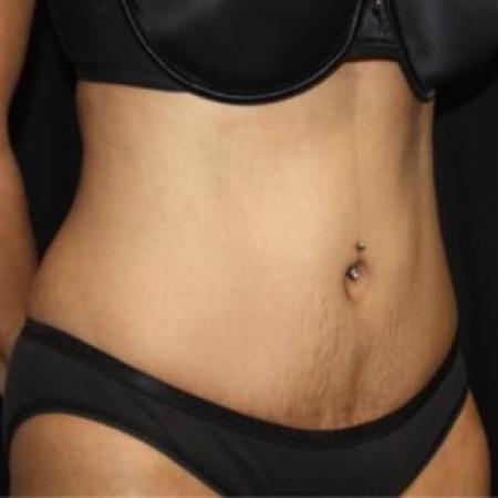 After image 2 Case #85591 - Abdominoplasty - 44 year old female