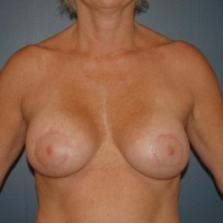 After image 1 Case #81226 - Bilateral periareolar breast lift with saline implants