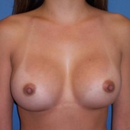 After image 1 Case #80671 - Breast Augmentation
