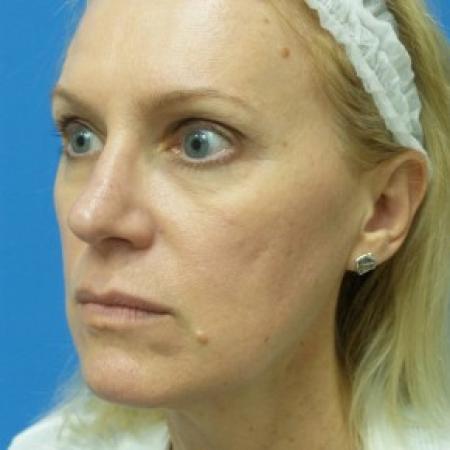 After image 2 Case #87096 - 49 year old  -  Rhinoplasty/Septoplasty/Turbinectomy  -  3 months post-op