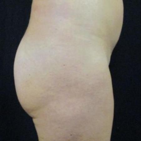 After Case #82641 - Fat transfer to Buttocks
