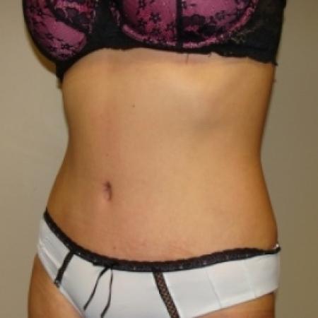 After image 3 Case #80116 - Abdominoplasty