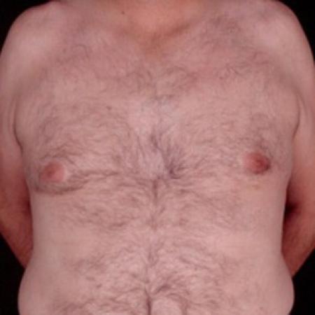 After image 1 Case #81506 - Gynecomastia