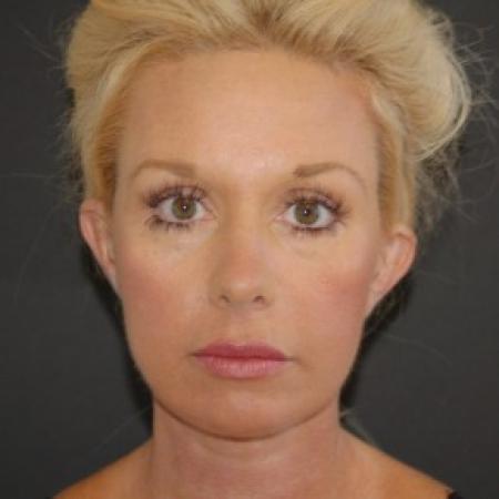 After image 1 Case #82826 - Face Lift, Neck Lift, and Endoscopic Forehead Lift 
