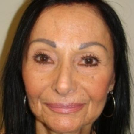 After image 1 Case #79546 - Rhinoplasty