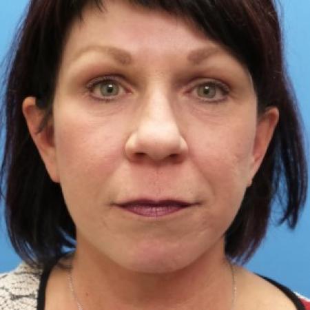 After image 1 Case #86566 - Facelift/Lower Blepharoplasty/Browlift/Laser Resurfacing to Full Face     4 months post-op