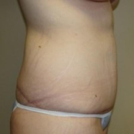 After image 3 Case #79486 - Tummy Tuck