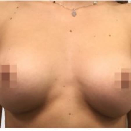 After image 1 Case #86981 - Breast Augmentation