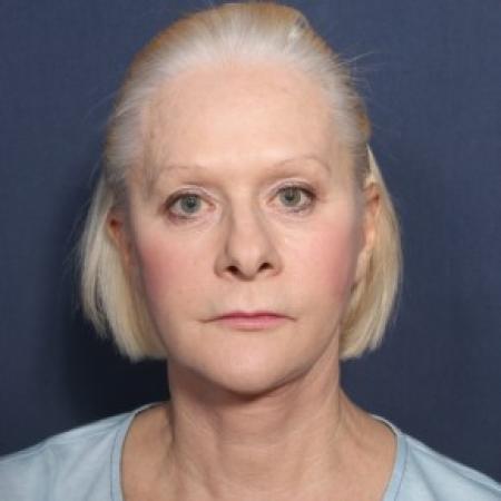 After image 1 Case #84361 - 67 Year Old Female