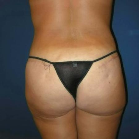 After image 2 Case #82816 - Extended Tummy Tuck and Liposuction