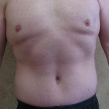 After image 1 Case #79926 - Tummy Tuck 