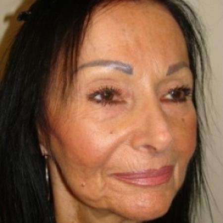 After image 4 Case #79546 - Rhinoplasty