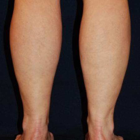 After image 3 Case #87641 - Lower Leg Liposuction