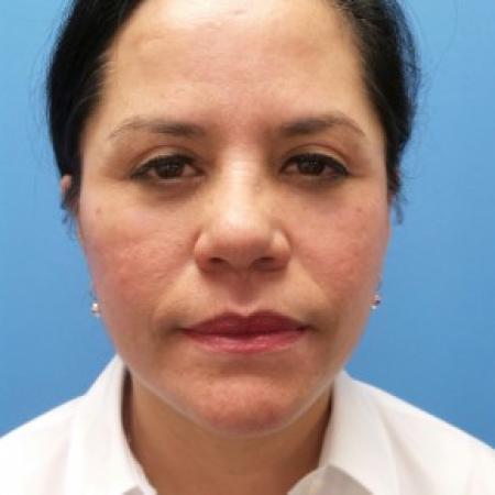 After image 1 Case #87341 - 54-year old - Upper & Lower Blepharoplasty/Facelift/Fat Grafting  to  Upper Cheeks & Lower Lids/Skin Resurfacing to both cheeks   3 months post-op