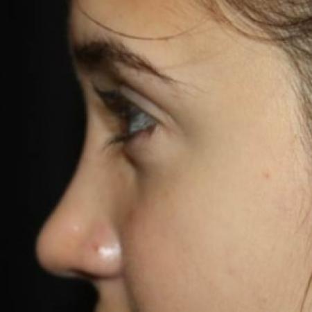 After image 3 Case #85141 - Rhinoplasty - 17 year old female