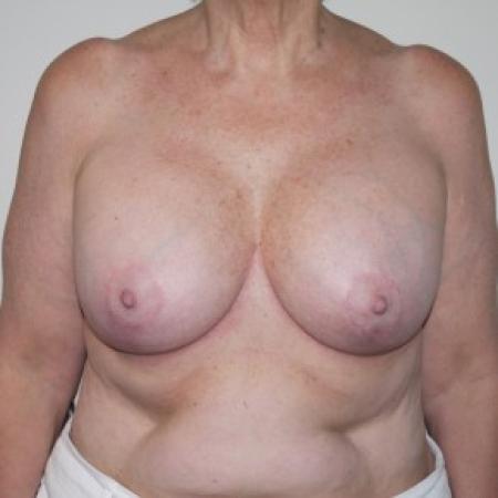 After image 1 Case #82361 - Augmentation Mastopexy
