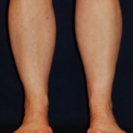After image 1 Case #87641 - Lower Leg Liposuction