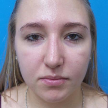 After image 1 Case #88316 - 19 year old  -  Open Rhinoplasty  -  6 months post-op