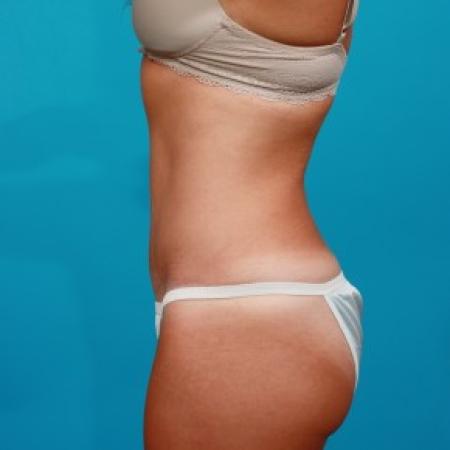 After image 3 Case #84106 - Abdominoplasty with Flank Lipo