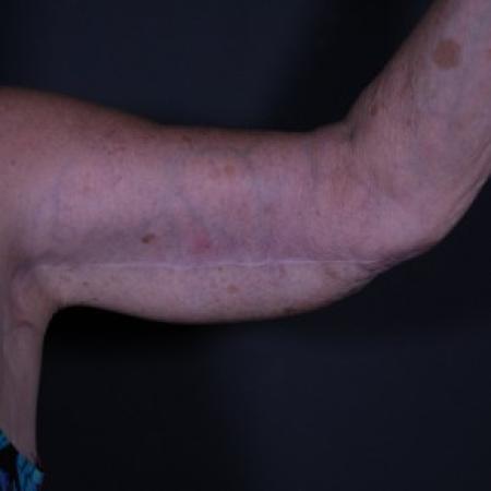 After image 1 Case #84176 - Arm Lift