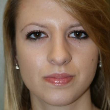 After image 1 Case #81881 - Open Structure Septorhinoplasty