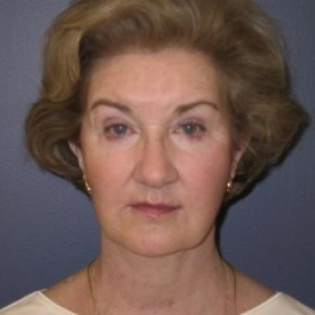 After image 1 Case #81051 - Facelift