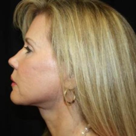 After image 3 Case #85286 - Facelift and Neck Lift - 54 year old female