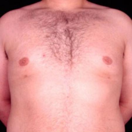 After image 1 Case #81511 - Gynecomastia