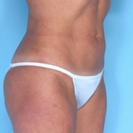 After image 3 Case #79241 - Liposuction