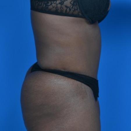 After image 2 Case #87871 - Tummy Tuck