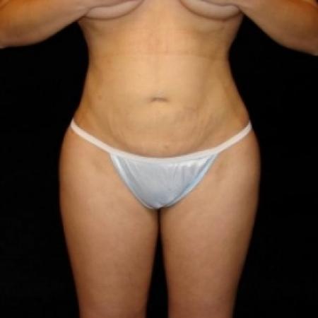 After image 1 Case #80331 - Buttocks Augmentation Via Fat Grafting with Liposuction of Abdomen, Waist, Flanks, Dorsal Roll, Inner and Outer Thighs