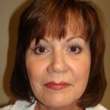 After image 1 Case #79616 - Facelift