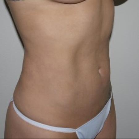 After image 2 Case #82561 - Liposuction of the abdomen and hips