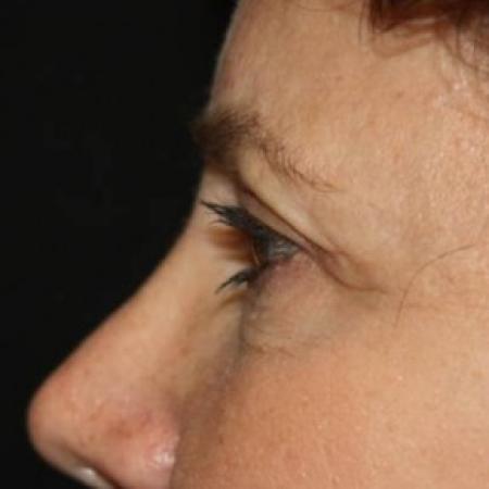 After image 3 Case #84271 - Brow Lift- 60 year old female