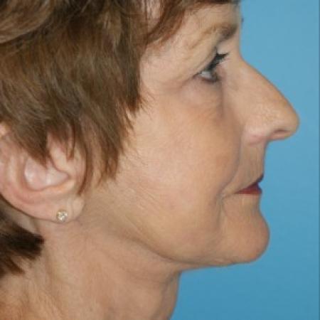 After image 3 Case #86621 - Facelift/Liposuction of the Neck/Laser Resurfacing to Full Face     3 months post-op