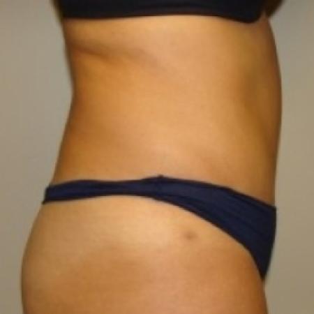 After image 3 Case #79501 - Tummy Tuck