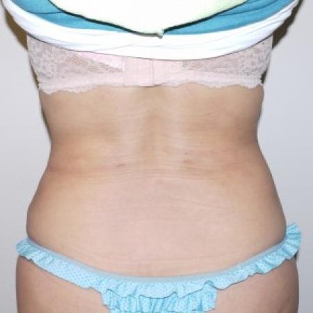 After image 1 Case #82376 - Ultrasonic liposuction back