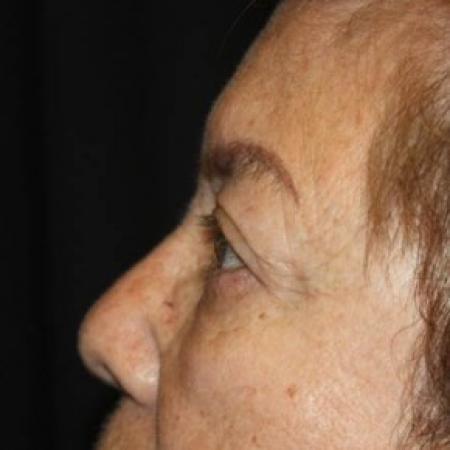 After image 3 Case #84706 - Blepharoplasty and Brow Lift - 78 year old female.