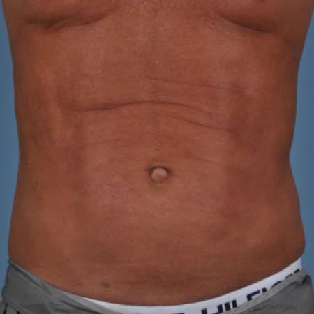 After image 1 Case #88296 - Male abdomen and hiprolls