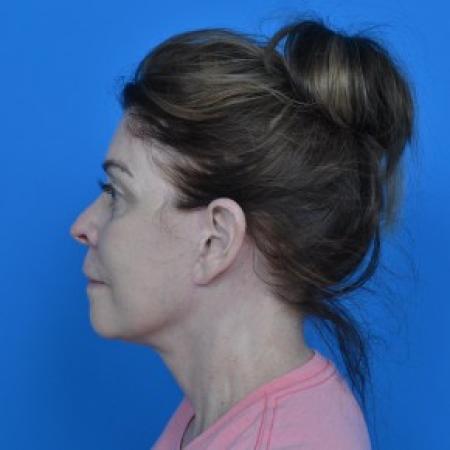 After image 3 Case #87926 - Facelift and Necklift