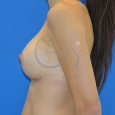After image 3 Case #87636 - Anatomical breast augmentation
