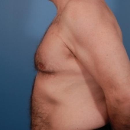 After image 3 Case #79066 - Gynecomastia Treatment