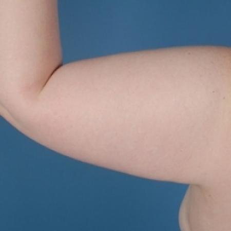 After image 2 Case #79016 - Arm Lift