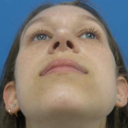 After image 4 Case #88391 - 25 year old  -  Rhinoplasty/Septoplasty/Partial Turbinectomy  -  7 months post-op