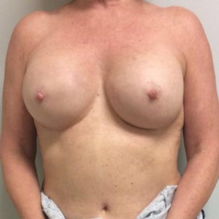 After image 1 Case #87276 - Nipple sparing mastectomies with immediate breast reconstruction with tissue expander to implant 