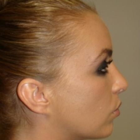 After image 2 Case #80476 - Open Rhinoplasty