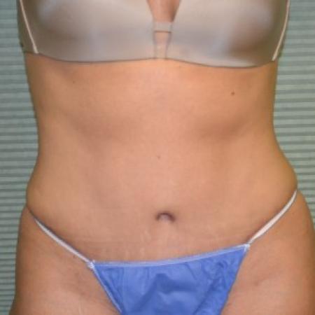 After image 1 Case #87886 - Tummy Tuck