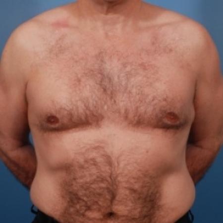 After image 1 Case #79066 - Gynecomastia Treatment