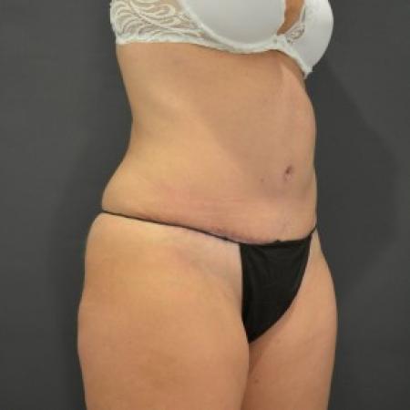 After image 1 Case #85696 - Liposuction 